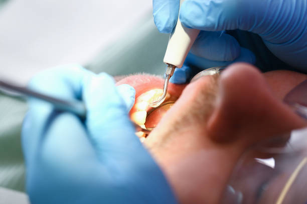 Best Emergency Treatment for Dental Infections or Abscesses in Youngsville, PA